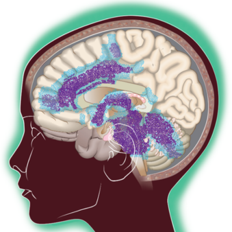 Cropped illustration showing network of highly connected brain regions involved in DMG