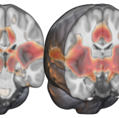 A map of the DMG network (red) across multiple brain regions