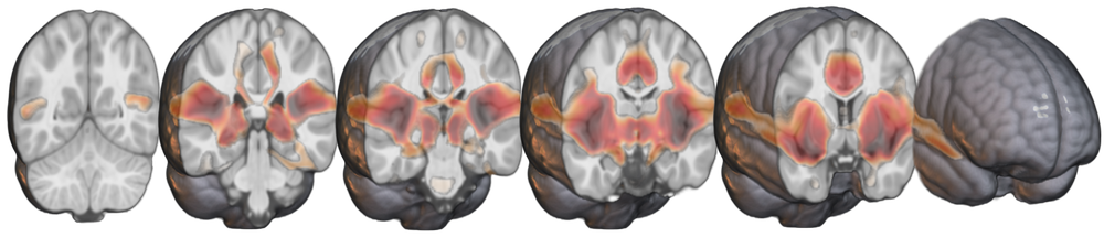A map of the DMG network (red) across multiple brain regions