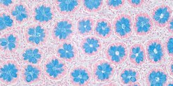 Winner of the 2025 GOSH research image competition. This floral image shows the colon of a patient with Hirschsprung disease, a rare childhood bowel disease.